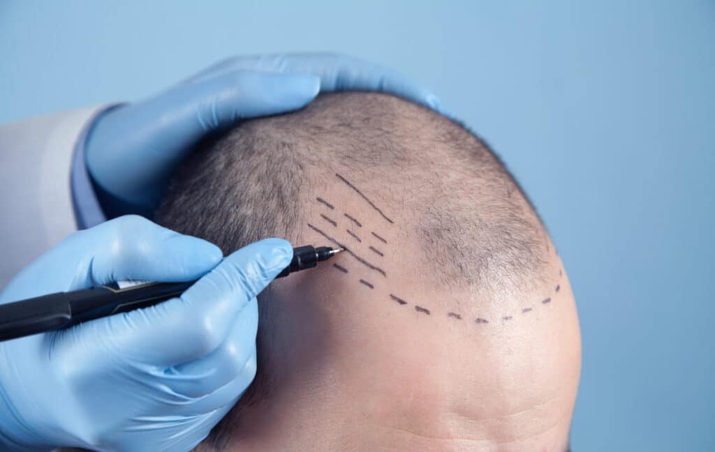 These advanced methods involve harvesting healthy hair follicles