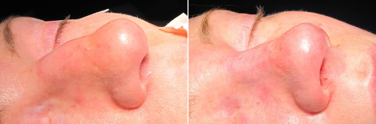 Immediate On Table Results Before and after photos in Sandy Springs, GA, Patient 27674
