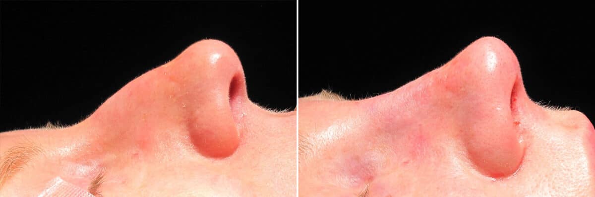 Immediate On Table Results Before and after photos in Sandy Springs, GA, Patient 27674