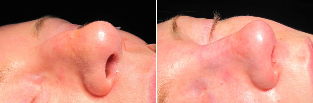 Immediate On Table Results Before and after photos in Sandy Springs, GA, Patient 27674