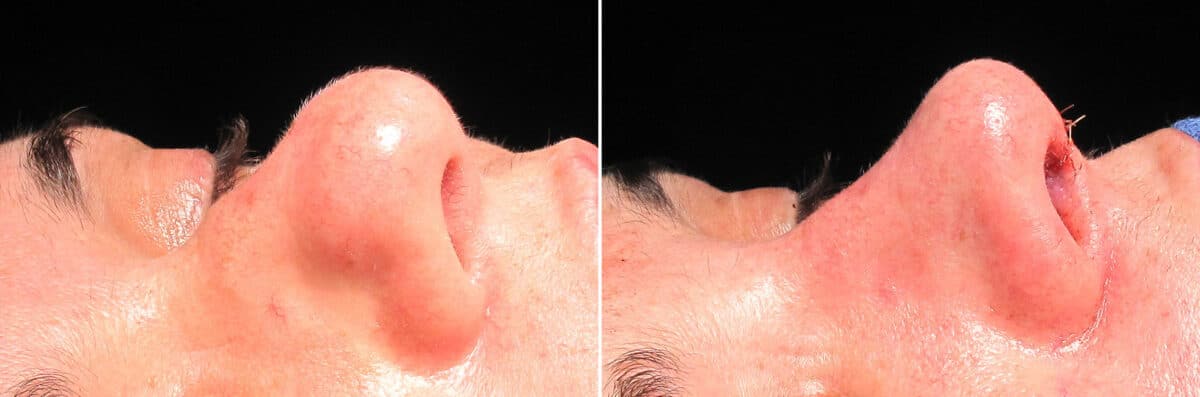 Immediate On Table Results Before and after photos in Sandy Springs, GA, Patient 27693