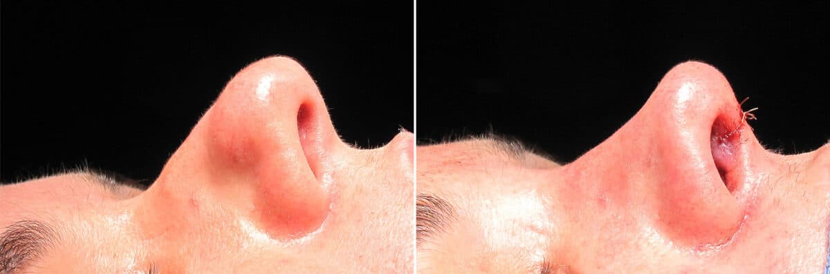 Immediate On Table Results Before and after photos in Sandy Springs, GA, Patient 27693