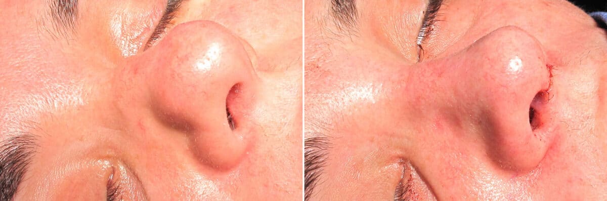Immediate On Table Results Before and after photos in Sandy Springs, GA, Patient 27693