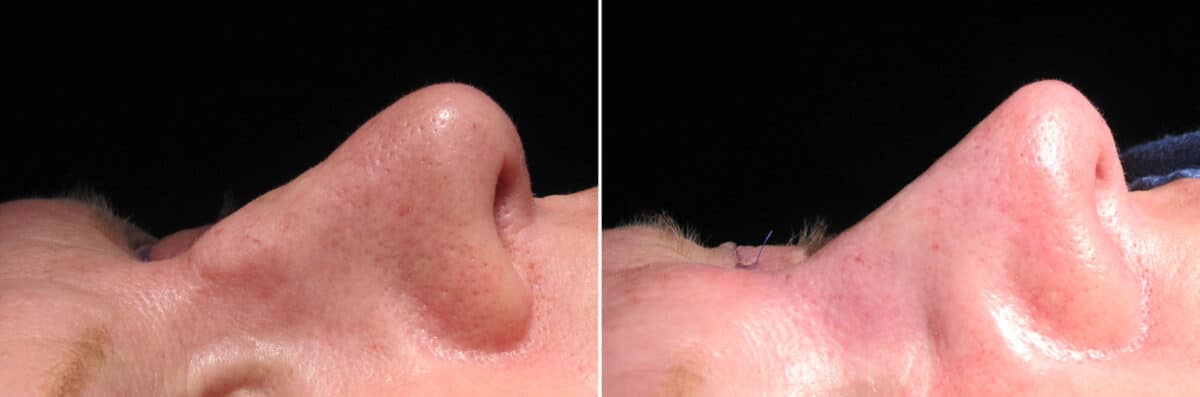 Immediate On Table Results Before and after photos in Sandy Springs, GA, Patient 27747