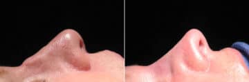 Immediate On Table Results Before and after photos in Sandy Springs, GA, Patient 27747