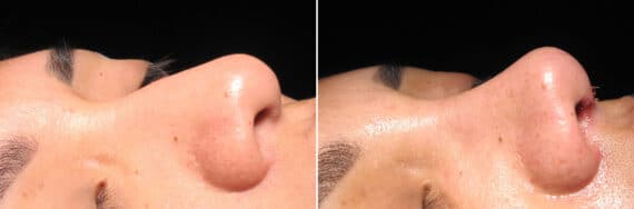 Immediate On Table Results Before and after photos in Sandy Springs, GA, Patient 27760
