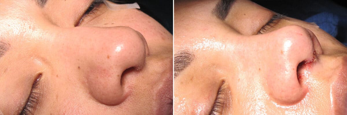 Immediate On Table Results Before and after photos in Sandy Springs, GA, Patient 27760