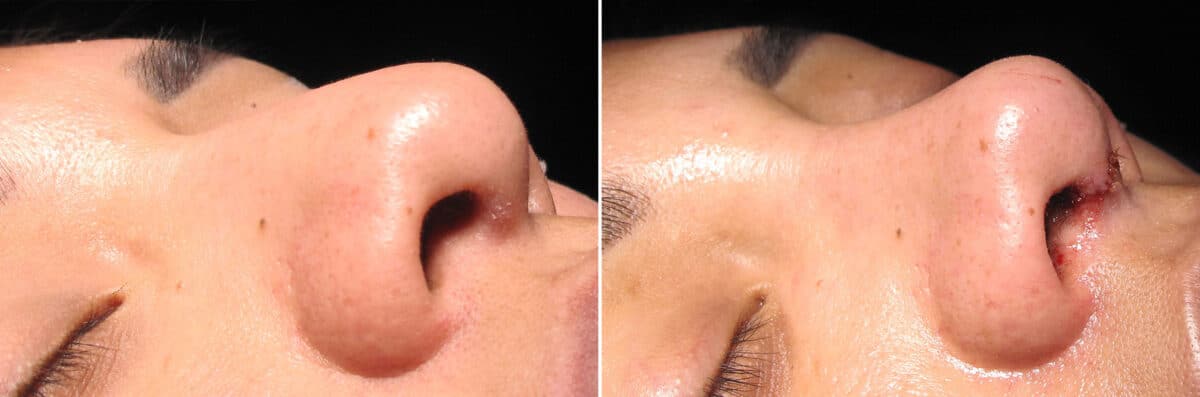 Immediate On Table Results Before and after photos in Sandy Springs, GA, Patient 27760