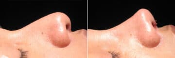 Immediate On Table Results Before and after photos in Sandy Springs, GA, Patient 27760