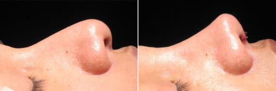 Immediate On Table Results Before and after photos in Sandy Springs, GA, Patient 27760