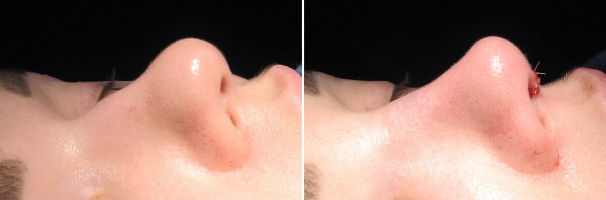 Immediate On Table Results Before and after photos in Sandy Springs, GA, Patient 27785