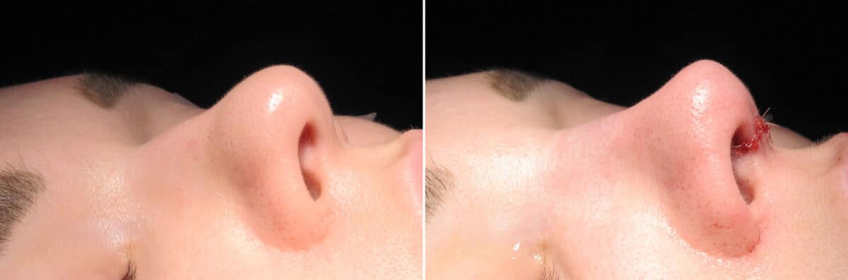 Immediate On Table Results Before and after photos in Sandy Springs, GA, Patient 27785