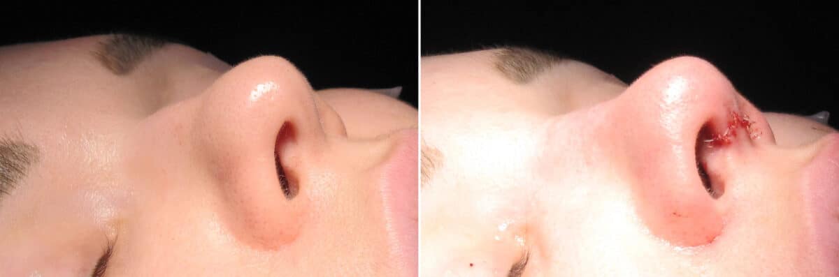 Immediate On Table Results Before and after photos in Sandy Springs, GA, Patient 27785