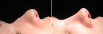 Immediate On Table Results Before and after photos in Sandy Springs, GA, Patient 27785