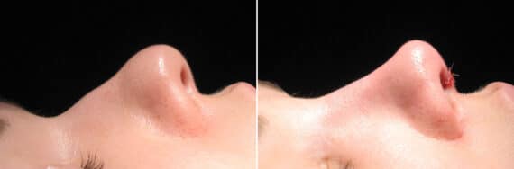 Immediate On Table Results Before and after photos in Sandy Springs, GA, Patient 27785
