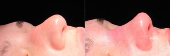 Immediate On Table Results Before and after photos in Sandy Springs, GA, Patient 27810