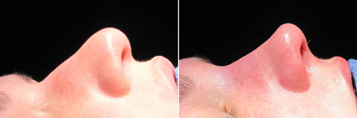 Immediate On Table Results Before and after photos in Sandy Springs, GA, Patient 27810