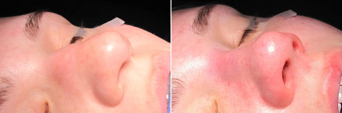 Immediate On Table Results Before and after photos in Sandy Springs, GA, Patient 27810