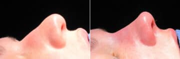 Immediate On Table Results Before and after photos in Sandy Springs, GA, Patient 27810