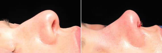 Immediate On Table Results Before and after photos in Sandy Springs, GA, Patient 27829