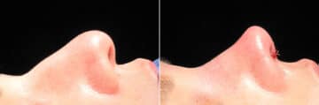 Immediate On Table Results Before and after photos in Sandy Springs, GA, Patient 27829
