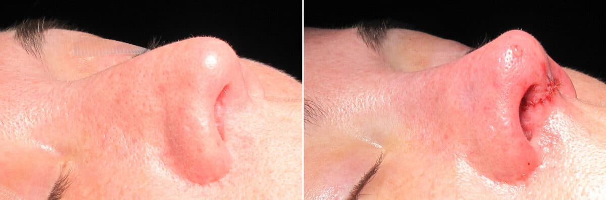 Immediate On Table Results Before and after photos in Sandy Springs, GA, Patient 27848