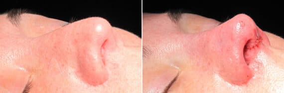 Immediate On Table Results Before and after photos in Sandy Springs, GA, Patient 27848