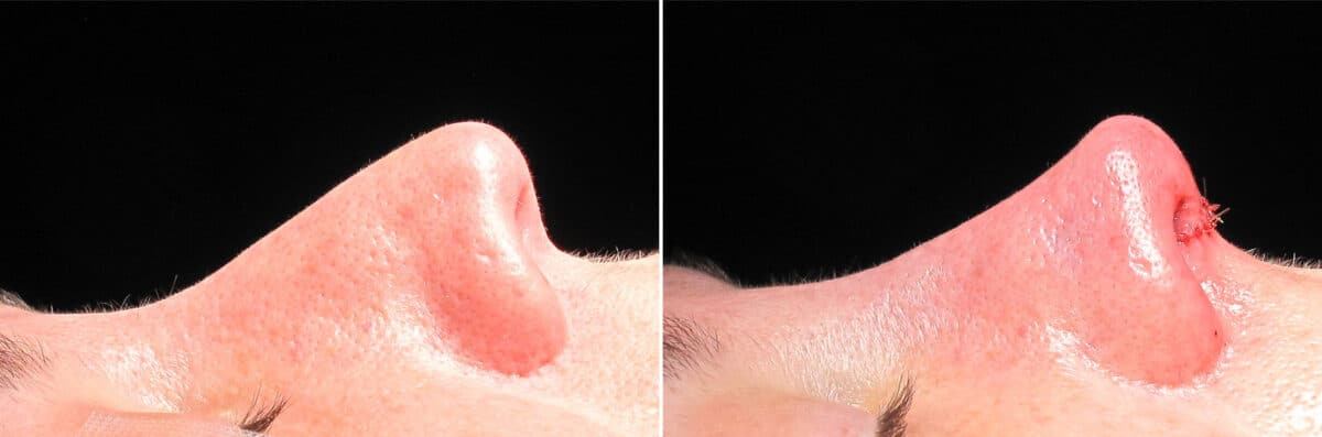 Immediate On Table Results Before and after photos in Sandy Springs, GA, Patient 27848
