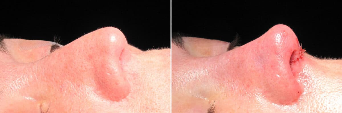 Immediate On Table Results Before and after photos in Sandy Springs, GA, Patient 27848