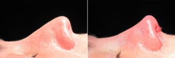 Immediate On Table Results Before and after photos in Sandy Springs, GA, Patient 27848