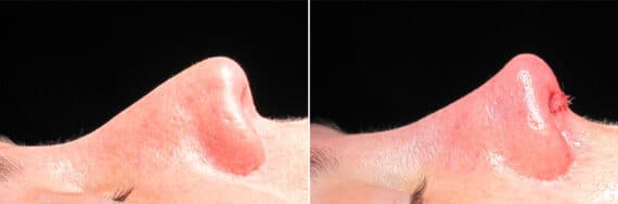 Immediate On Table Results Before and after photos in Sandy Springs, GA, Patient 27848