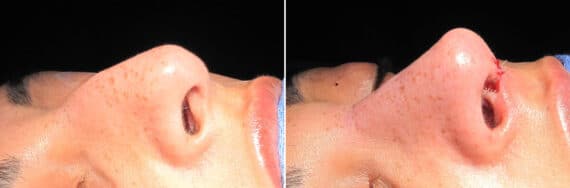 Immediate On Table Results Before and after photos in Sandy Springs, GA, Patient 27867