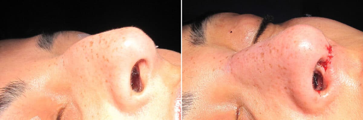 Immediate On Table Results Before and after photos in Sandy Springs, GA, Patient 27867