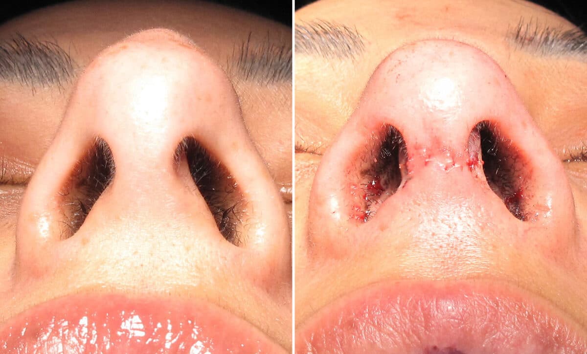 Immediate On Table Results Before and after photos in Sandy Springs, GA, Patient 27867
