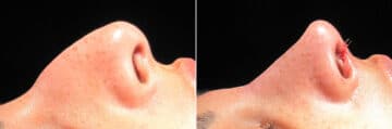 Immediate On Table Results Before and after photos in Sandy Springs, GA, Patient 27867