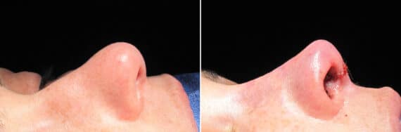 Immediate On Table Results Before and after photos in Sandy Springs, GA, Patient 27894