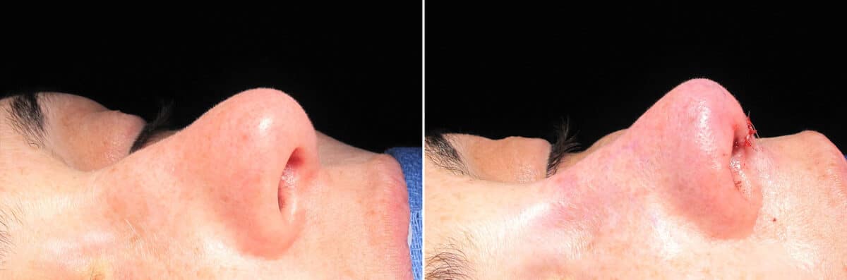Immediate On Table Results Before and after photos in Sandy Springs, GA, Patient 27894