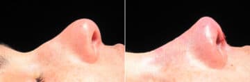 Immediate On Table Results Before and after photos in Sandy Springs, GA, Patient 27894
