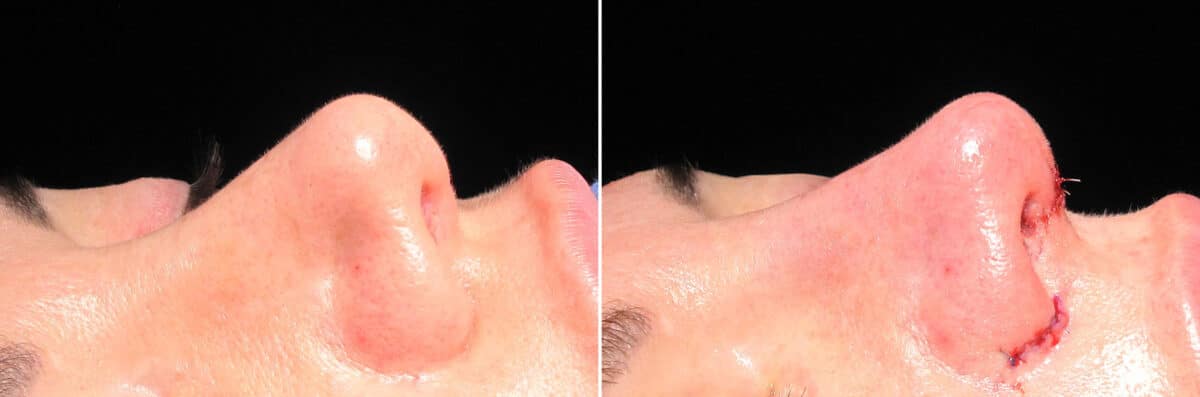 Immediate On Table Results Before and after photos in Sandy Springs, GA, Patient 27913