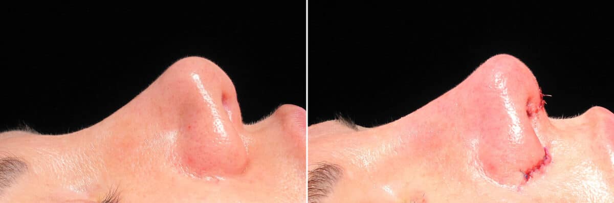 Immediate On Table Results Before and after photos in Sandy Springs, GA, Patient 27913