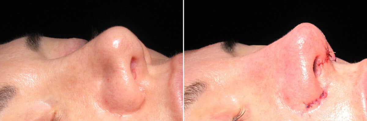 Immediate On Table Results Before and after photos in Sandy Springs, GA, Patient 27913