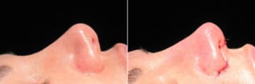 Immediate On Table Results Before and after photos in Sandy Springs, GA, Patient 27913