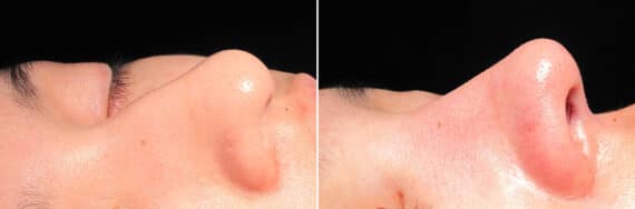 Immediate On Table Results Before and after photos in Sandy Springs, GA, Patient 27932
