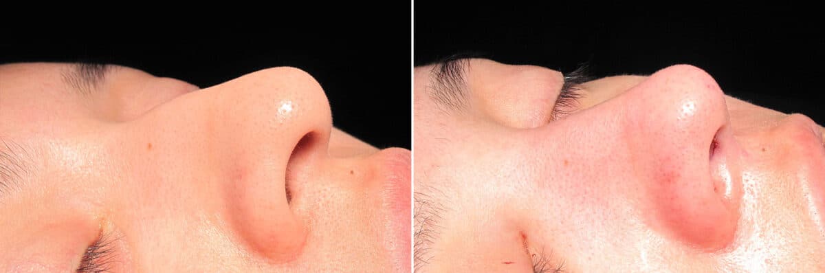 Immediate On Table Results Before and after photos in Sandy Springs, GA, Patient 27932