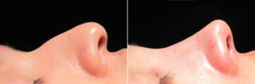 Immediate On Table Results Before and after photos in Sandy Springs, GA, Patient 27932