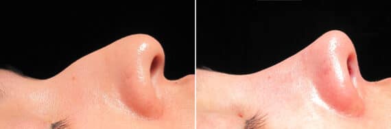 Immediate On Table Results Before and after photos in Sandy Springs, GA, Patient 27932