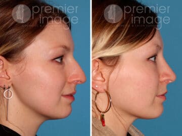 Rhinoplasty Before and after photos in Sandy Springs, GA, Patient 25874