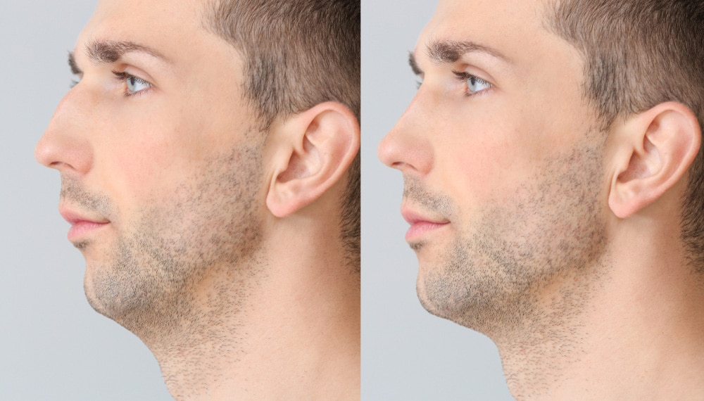 Injury to the nose can be effectively addressed through rhinoplasty, restoring both form and function.