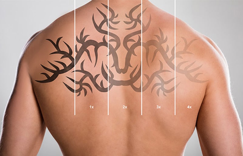 Laser Tattoo Removal | Atlanta, GA