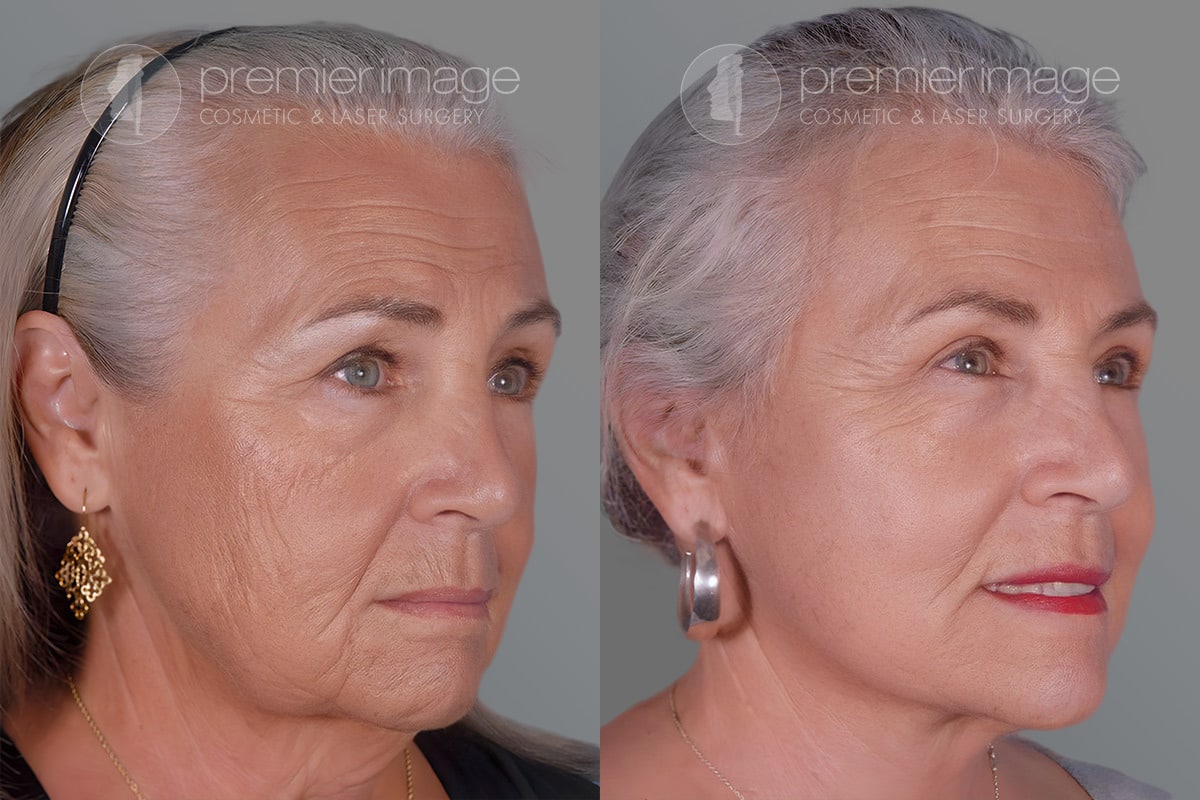 Patient 28104, Before and after photos Eyelid Surgery (Blepharoplasty) Before and after photos in Sandy Springs, GA, Patient 17222